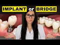 Dental Implant or Bridge Avoid This Costly Mistake