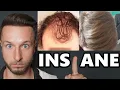 Best Finasteride Rogaine Hair Loss Recoveries NW3 - NW6