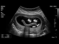 😂 Funny Stomach Ultrasound for Kids | Too Much Junk Food Inside?