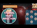 CAN PROBIOTICS HELP TREAT VAGINAL YEAST INFECTIONS HOW TO PREVENT THIS INFECTIONS THE CAUSES