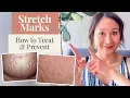How to Treat and Prevent Stretch Marks And the Products I Use Dr Jenny Liu