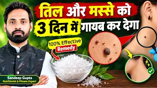 तिल और मस्से को जड़ से ख़त्म करने का सबसे अच्छा उपाय Remove Skin Tags