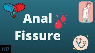 anal fissure causes signs and symptoms diagnosis and treatment