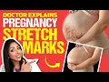 TREAT Stretchmarks during Pregnancy Doctor V explains