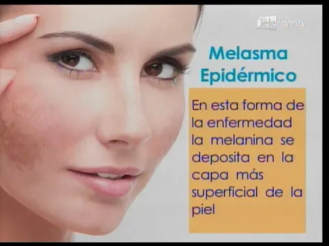 Manchas en la piel: Cuando el melasma afecta tu cutis