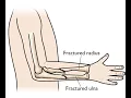 Fracture Closed treatment Radial and Ulnar CPT code - simplify medical coding