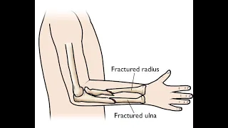 Fracture Closed treatment Radial and Ulnar CPT code - simplify medical coding