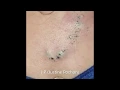 Blackheads Pimple