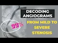 How Your Cardiologist Determines the Degree of Blockage What is a Severe Stenosis