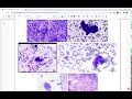 Rapid Onsite Evaluation for EBUS specimens - Dr Hoda Amer