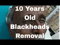10 Years old Blackheads