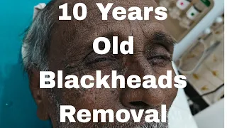 10 Years old Blackheads
