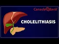 Cholelithiasis Gallstones Causes Symptoms Treatment Surgery GI CanadaQBank
