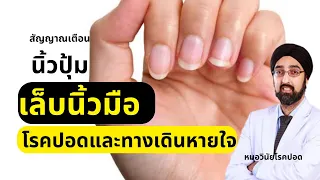 นิ้วปุ้มสามารถหายหรือหยุดพัฒนาได้ไหม ถ้าพบตั้งแต่เนิ่นๆ