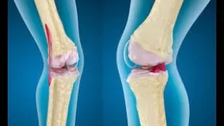 رقية شرعي ة تشفي بفضل الله آلام الركب و المفاصل 