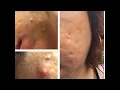 Skin Tightening at Panacea Massage Spa Houston TX