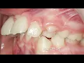 Protect Your Smile by Correcting Teeth