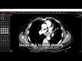 MedDream DICOM Viewer mark and store the ROI region of interest