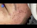 Huge Inflamed Cyst and Zit Removal - Don t Watch While Eating