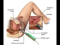 Cystourethroscopy with Meatotomy CPT code - simplify medical coding
