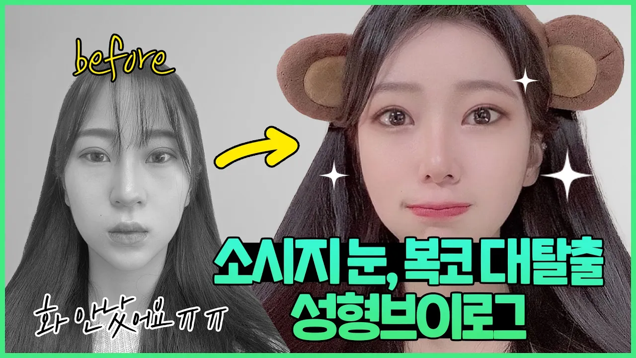 [VLOG] 소시지 눈, 복코 탈출기! 화난 인상에서 순한 인상으로 변신! 🤩 #눈매교정 #눈성형 #코성형