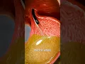 Download Lagu How A Gastric Balloon Works 🤔