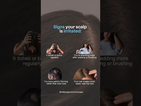 Signs Your Scalp Is Irritated and Causing Hair Loss