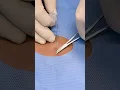 Loop Technique of Abscess Drainage