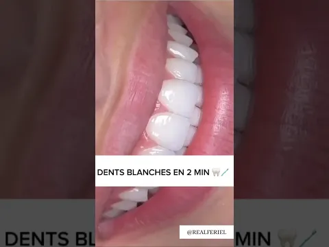 BLANCHIR SES DENTS EN 2 MINUTES 🤩🦷 #astucesbeauté  #diy  #astuce #whiteningteeth #blanchiment