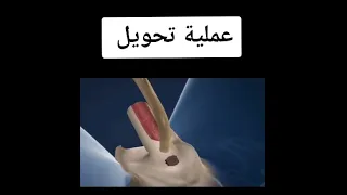 عملية تحويل مهند الرديني من ذكر ألى أنثى الفيديو لايناسب أصحاب القلوب الضعيفه 