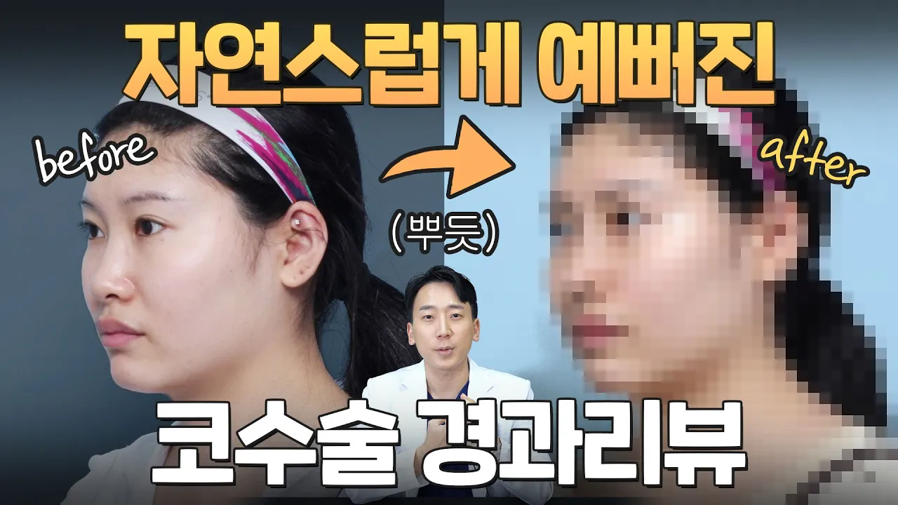 7일 만에 빠진 붓기?! 제가 수술한 환자 코 리뷰