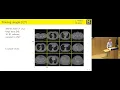 Local Patches Meet Global Context Scalable 3D Diffusion Priors for Image Reconstruction