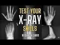 X-RAY Quiz - 10 Clinical Cases Hand Wrist and Foot Fractures Urgent Care