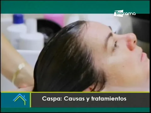 Caspa: Causas y tratamientos