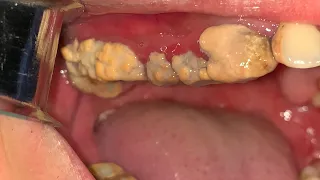 Professional Dental Cleaning | Severe Tartar Removal