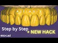 All-on-X 2025 EXOCAD 3 2 Tutorial In Detail