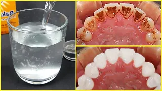 Usar Esto Para Enjuagarse La Boca - Quitar La Placa Y El Sarro De Los Dientes Rápidamente