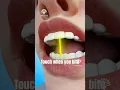 Open Bite Surgery What Really Happens - creativelearning3d