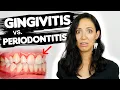 Do You Have Gingivitis or Periodontitis Different Stages Of Gum Disease