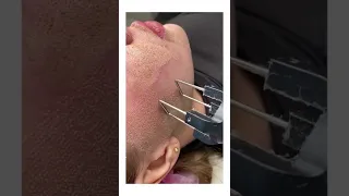 شاهد تغير ليزر ازاله ندب وتقعرات وتقليص المسامات بشره جميله وناعمه وتخلص من الطبقه الميته  شاهد تغير ليزر ازاله ندب وتقعرات وتقليص المسامات بشره جميله وناعمه وتخلص من الطبقه الميته