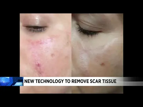 Download MP3 New technology to remove scar tissue comes to Roanoke