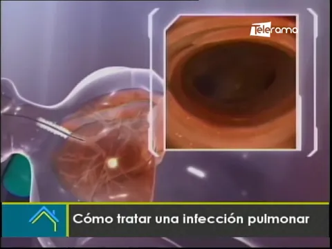 Cómo tratar una infección pulmonar