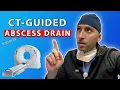 Emergent Abscess Drainage in under 30sec - Interventional Radiology