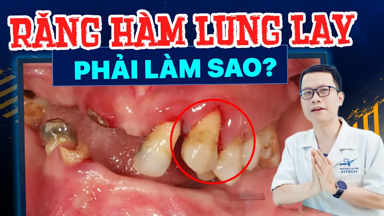 Outline Video Răng Hàm Lung Lay Phải Làm Sao? Đừng Tự Nhổ Khi Chưa Xem Video Này!