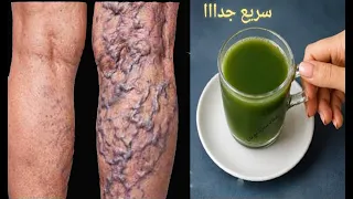 جعله الله علاج دوالي الساقين يشفي بسرعة جميع انواع الدوالي ادهش الاطباء