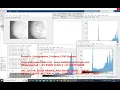 Contrast Limited Adaptive Histogram Equalization for mammography images MATLAB CLAHE code