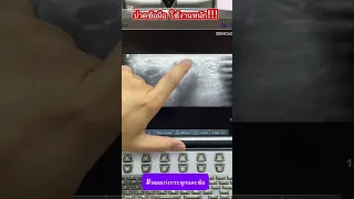  ทำไมข้อมือถึงเจ็บที่บริเวณรากนิ้วมือ และเกิดจากสาเหตุอะไรบ้าง 