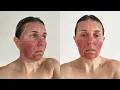 Download Lagu CO2 Fractional Laser: Recovery Day by Day