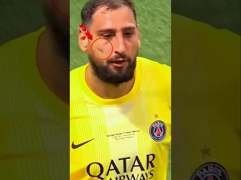 How Donnarumma Got That Scar on His Face! 😨