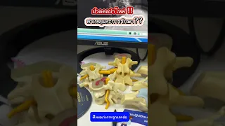  อาการปวดคอร้าวลงสะบักและชาลงแขนเกิดจากสาเหตุอะไร 